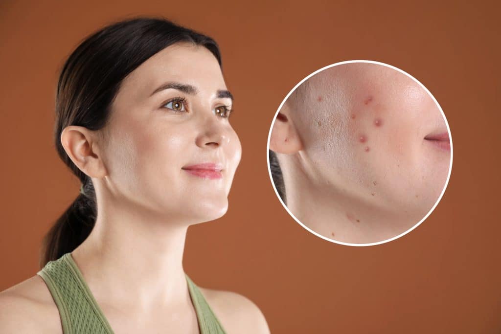 Best Treatment for Blemishes