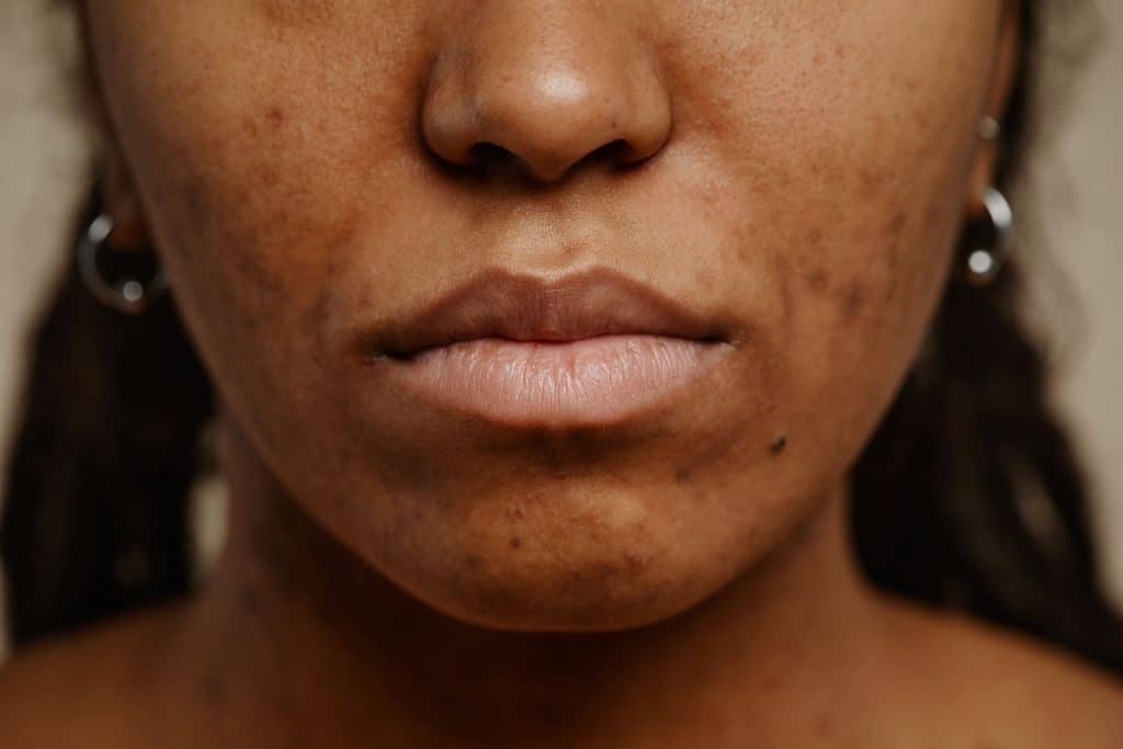 Best Treatment for Hyperpigmentation in Black Skin